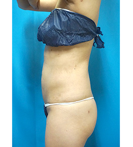 治療後のお腹症例写真