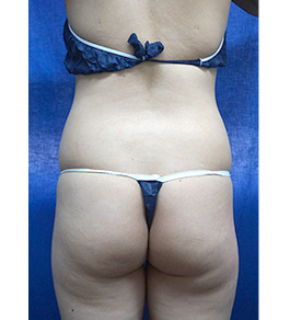 治療前のお腹症例写真