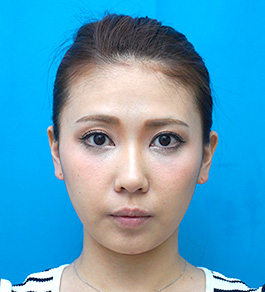 脂肪吸引 治療後の顎症例写真