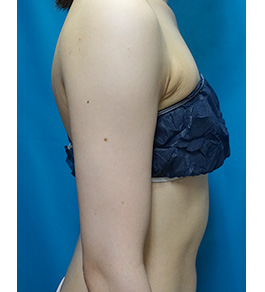 治療後の二の腕症例写真