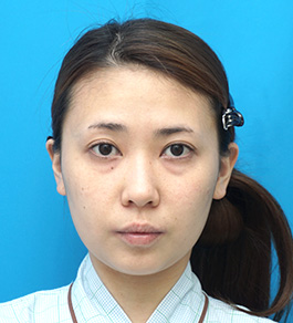 脂肪吸引 治療前の顎症例写真