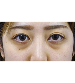 目の下のクマ・たるみ治療　術前