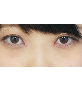 目の下のクマ・たるみ治療　術後