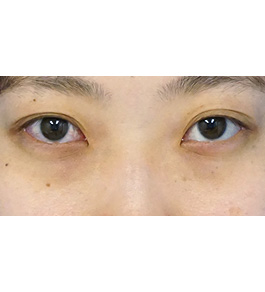 目の下のクマ・たるみ治療　術前