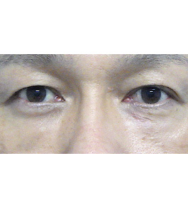 目の下のクマ・たるみ治療　術後
