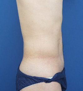 治療後のお腹症例写真
