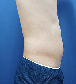 治療前のお腹症例写真