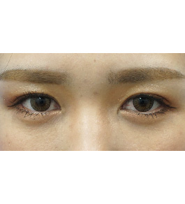 目の美容整形　術後