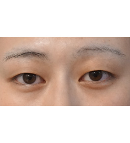 脂肪吸引 治療前の顎症例写真