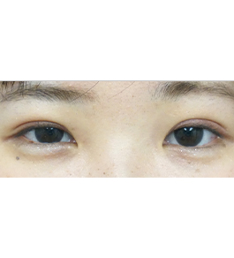 目の美容整形　術後