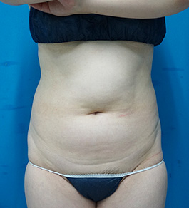 治療前のお腹症例写真