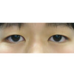 目の美容整形　術前