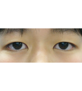 脂肪吸引 治療前の顎症例写真