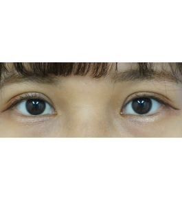 目の美容整形　術後