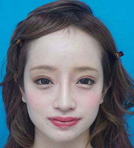 脂肪吸引 治療後の顎症例写真