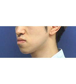脂肪吸引 治療前の顎症例写真