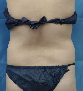 治療前のお腹症例写真
