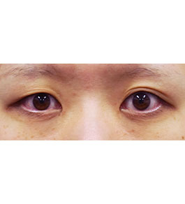 脂肪吸引 治療前の顎症例写真
