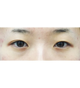 脂肪吸引 治療前の顎症例写真