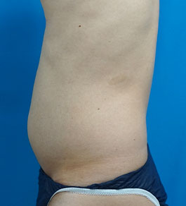 治療前のお腹症例写真
