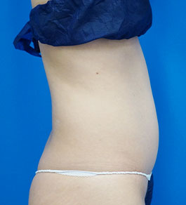 治療前のお腹症例写真