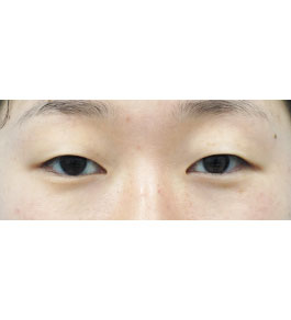 脂肪吸引 治療前の顎症例写真