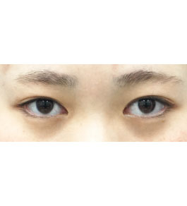 脂肪吸引 治療前の顎症例写真