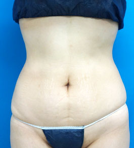治療前のお腹症例写真