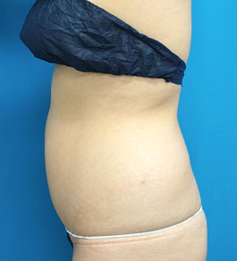 治療前のお腹症例写真