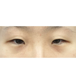 脂肪吸引 治療前の顎症例写真
