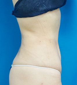 治療後のお腹症例写真