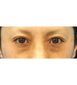脂肪吸引 治療前の顎症例写真