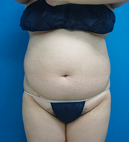 治療前のお腹症例写真