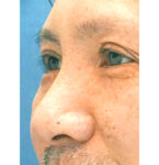 鼻のプロテーゼ