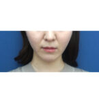 No.A-CL0067　術後