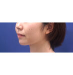 No.A-CL0069　術後