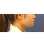 No.A-CL0068　術後