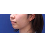 No.A-CL0069　術前