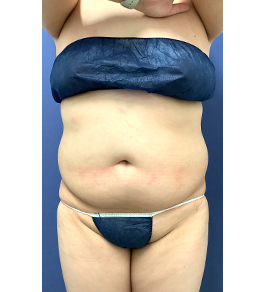 治療前のお腹症例写真