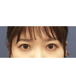 脂肪吸引 治療後の顎症例写真