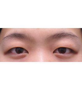 脂肪吸引 治療前の顎症例写真