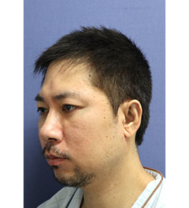 脂肪吸引 治療後の顎症例写真