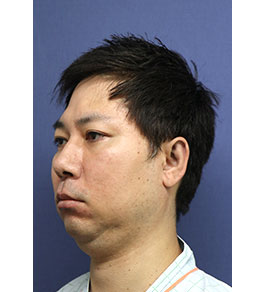 脂肪吸引 治療前の顎症例写真