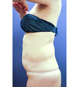 治療後のお腹症例写真