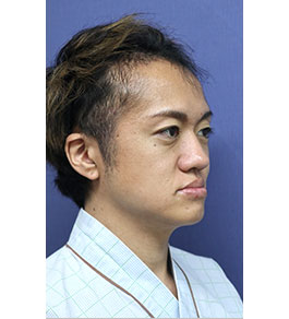 脂肪吸引 治療前の顎症例写真