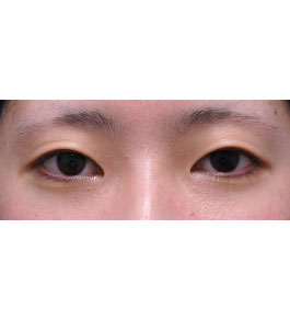 脂肪吸引 治療前の顎症例写真
