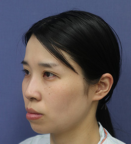 脂肪吸引 治療前の顎症例写真