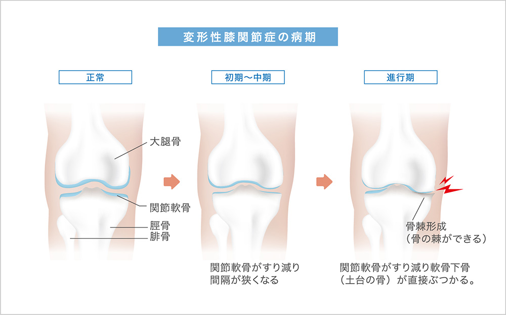 変形性膝関節症の病期